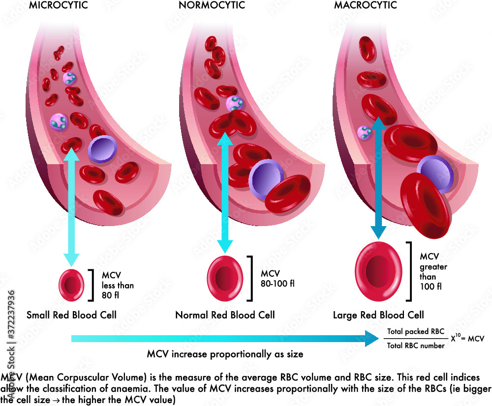 Macrocytic anemia blood cells