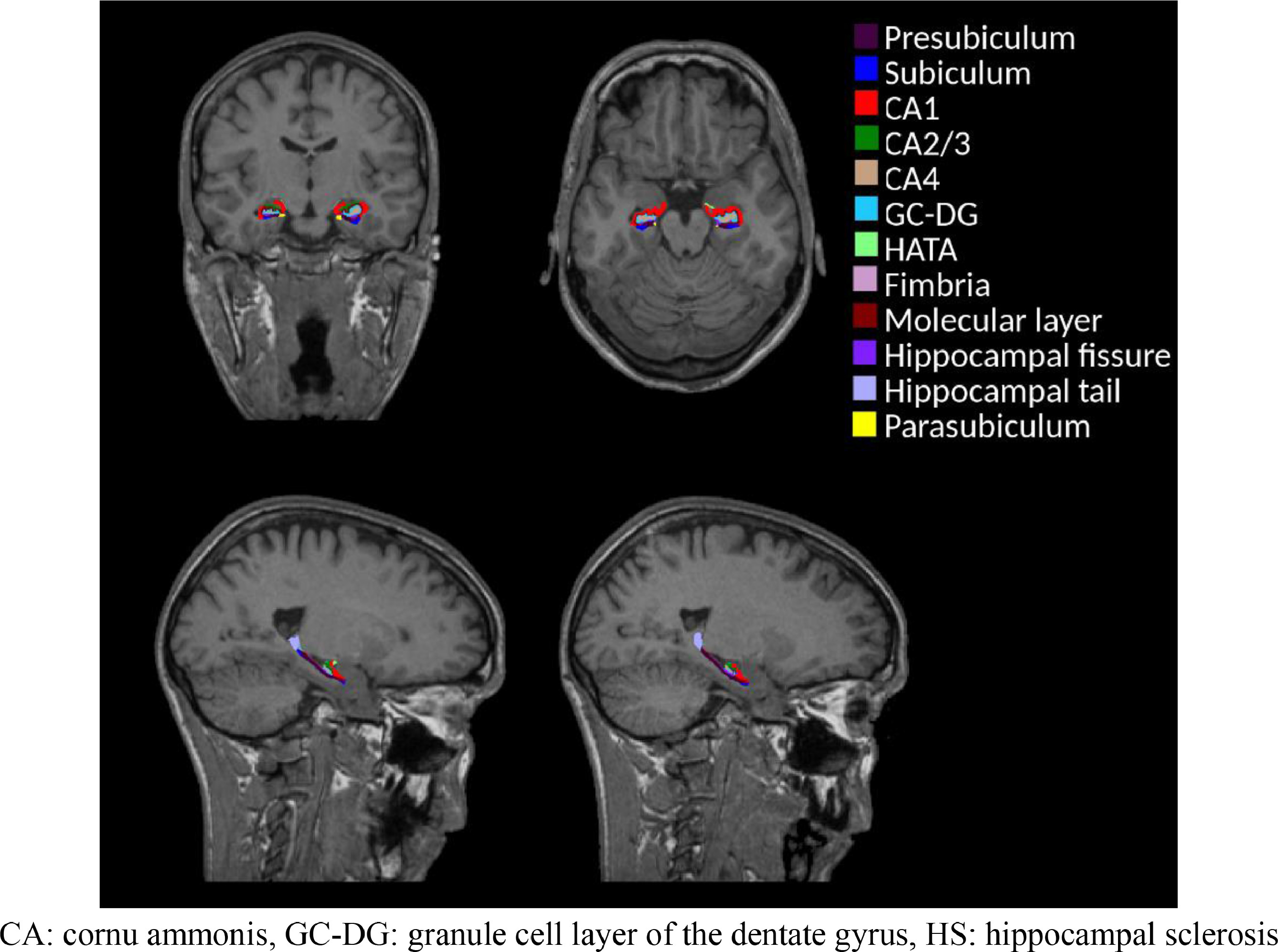 medical brain scan hippocampus