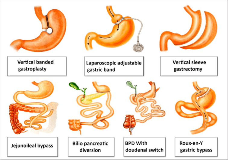 bariatric surgery procedure