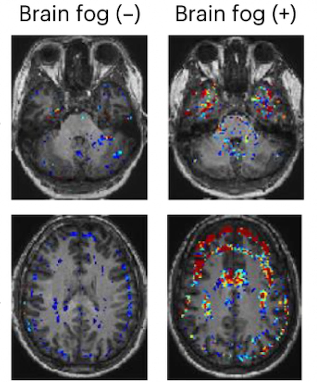 Brain Scans Suggest Vascular Cause for Long COVID Brain Fog