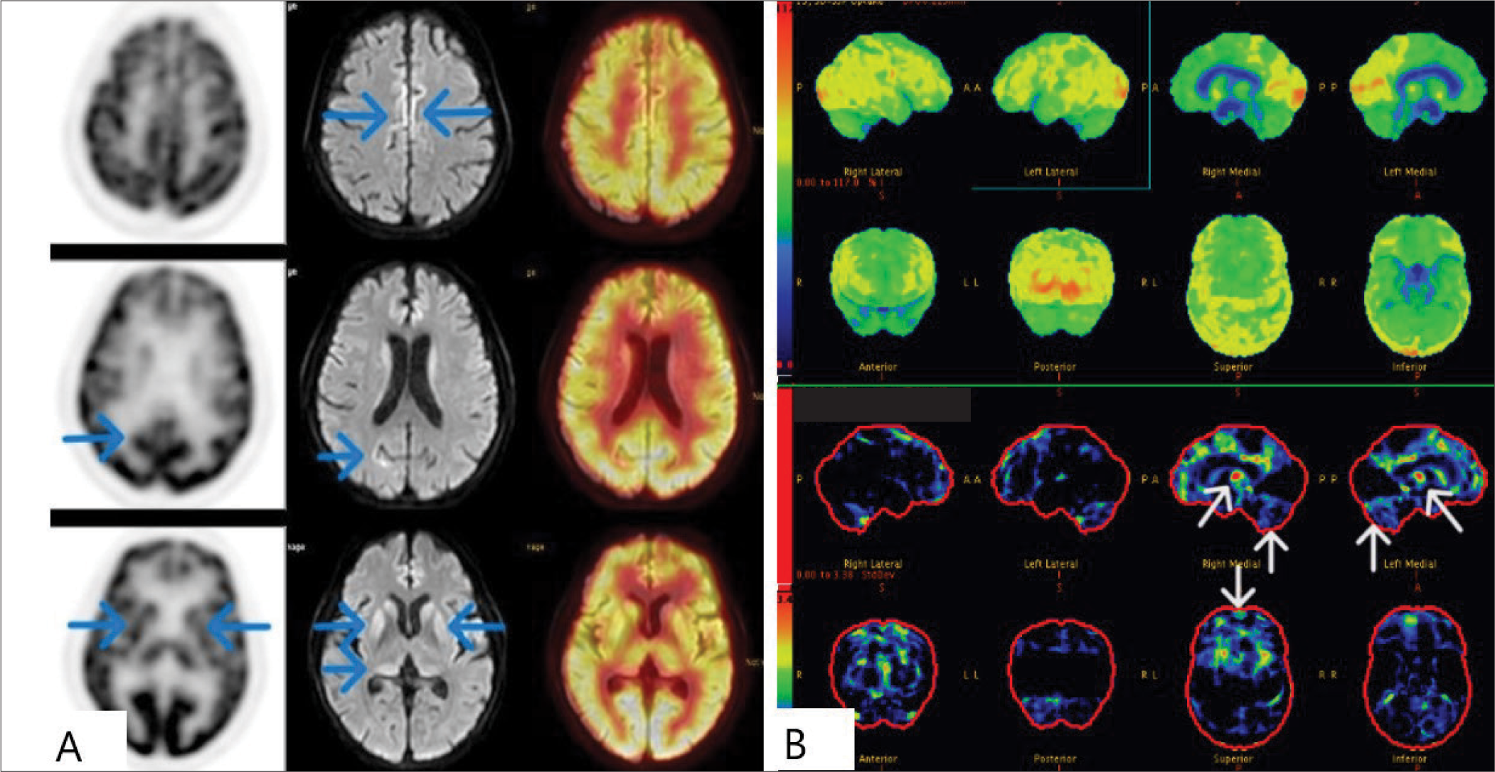 FDG-PET brain hypometabolism