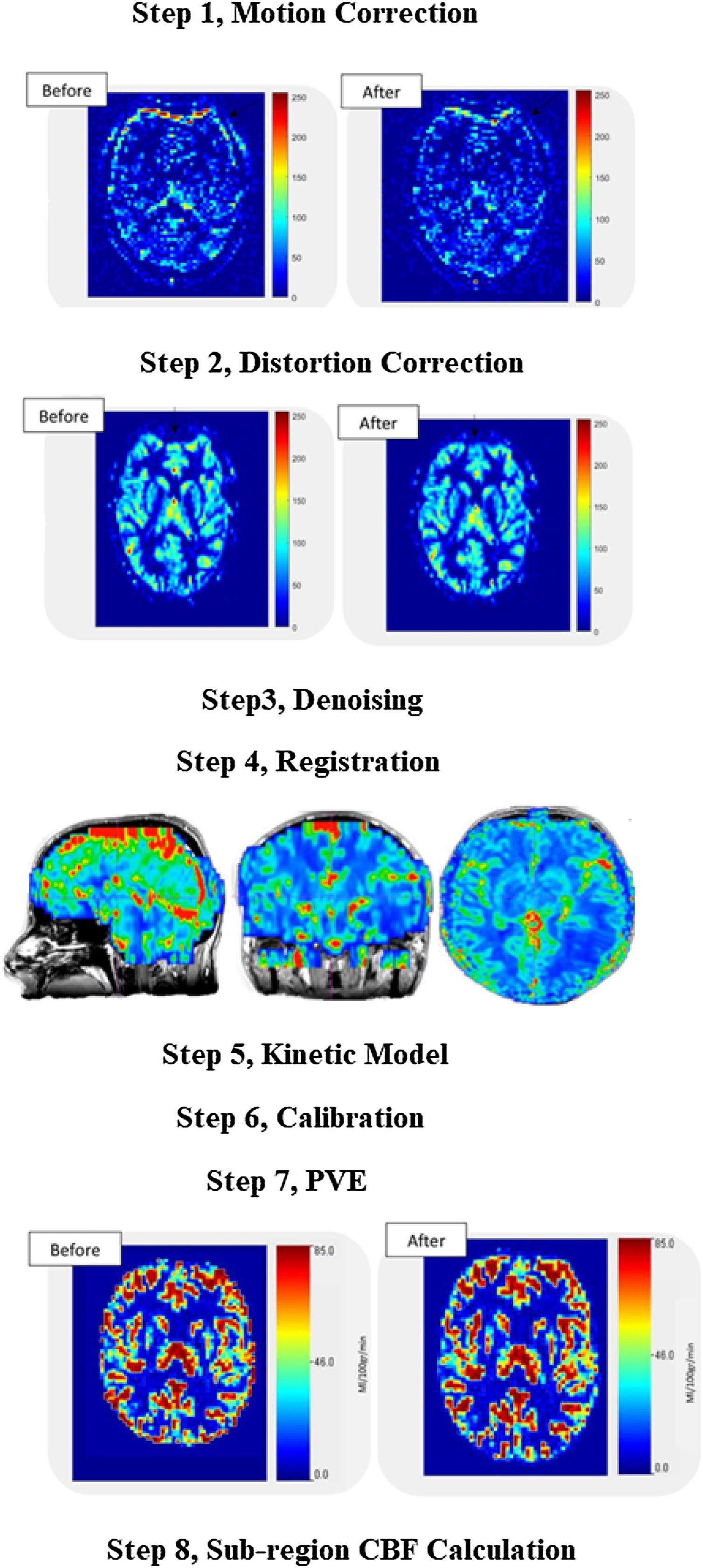 ASL MRI cerebral blood flow