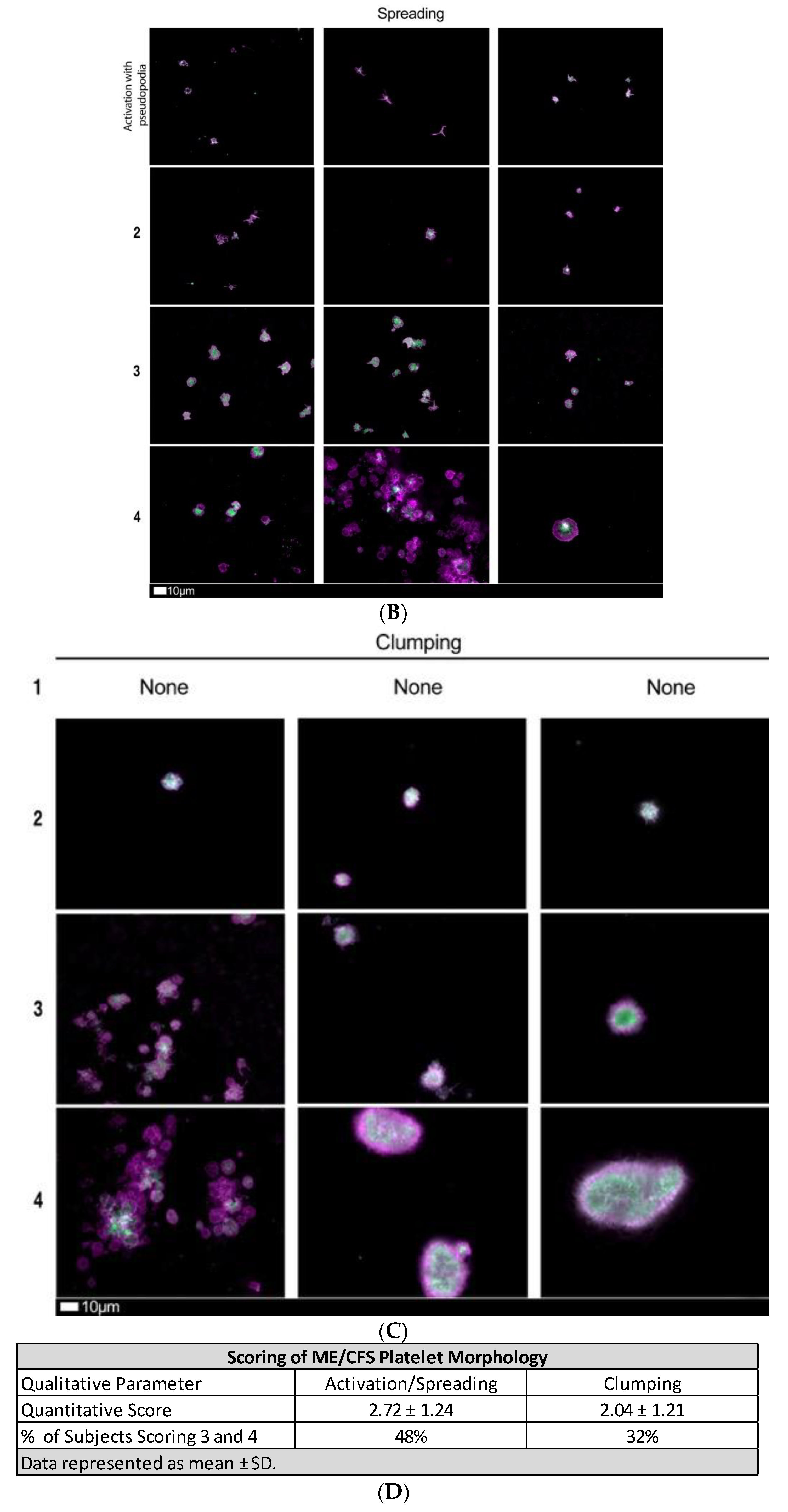 fibrinaloid microclots microscopy
