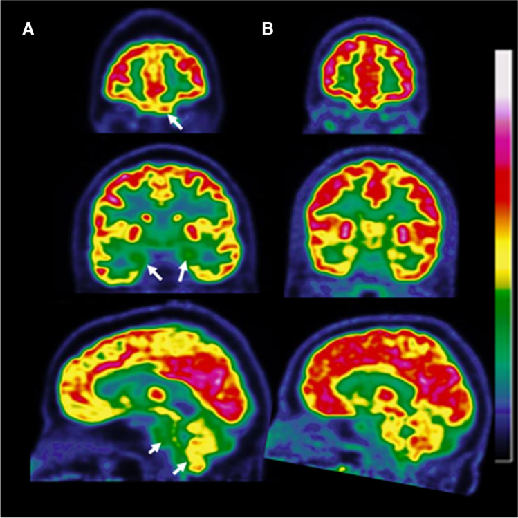neuroimaging long COVID brain