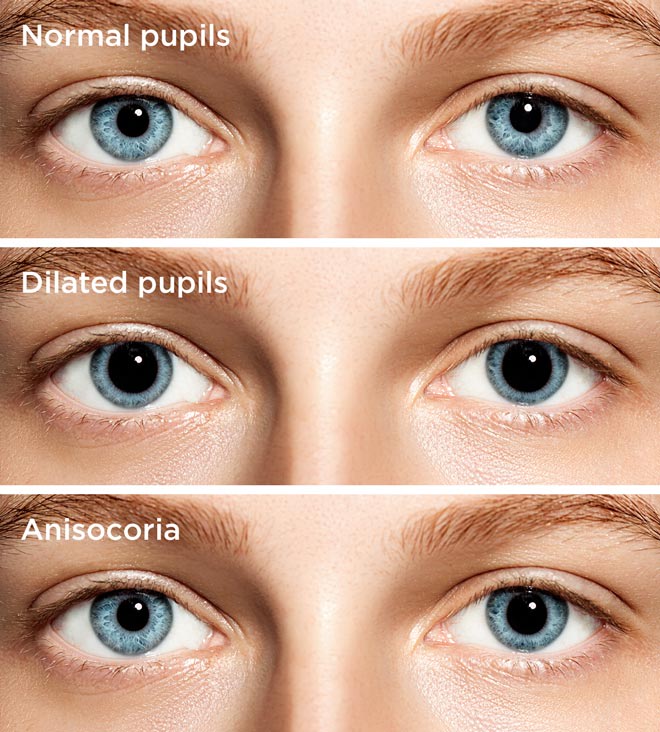 pupil dilation child depression