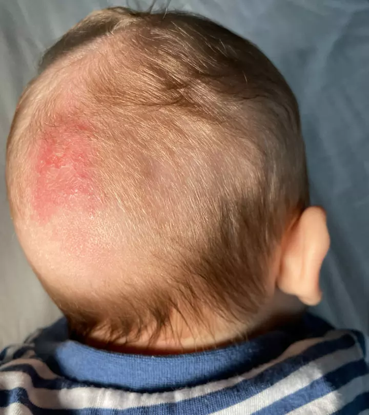 Cold Sores and Babies: The Hidden Risk of HSV Encephalitis