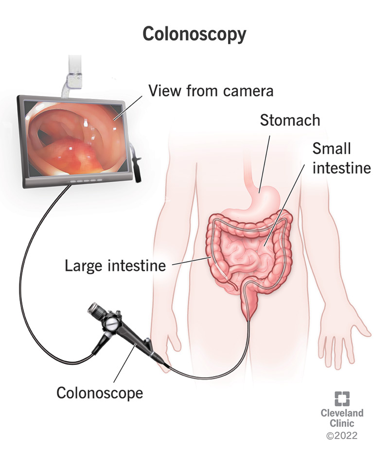 colonoscopy screening procedure