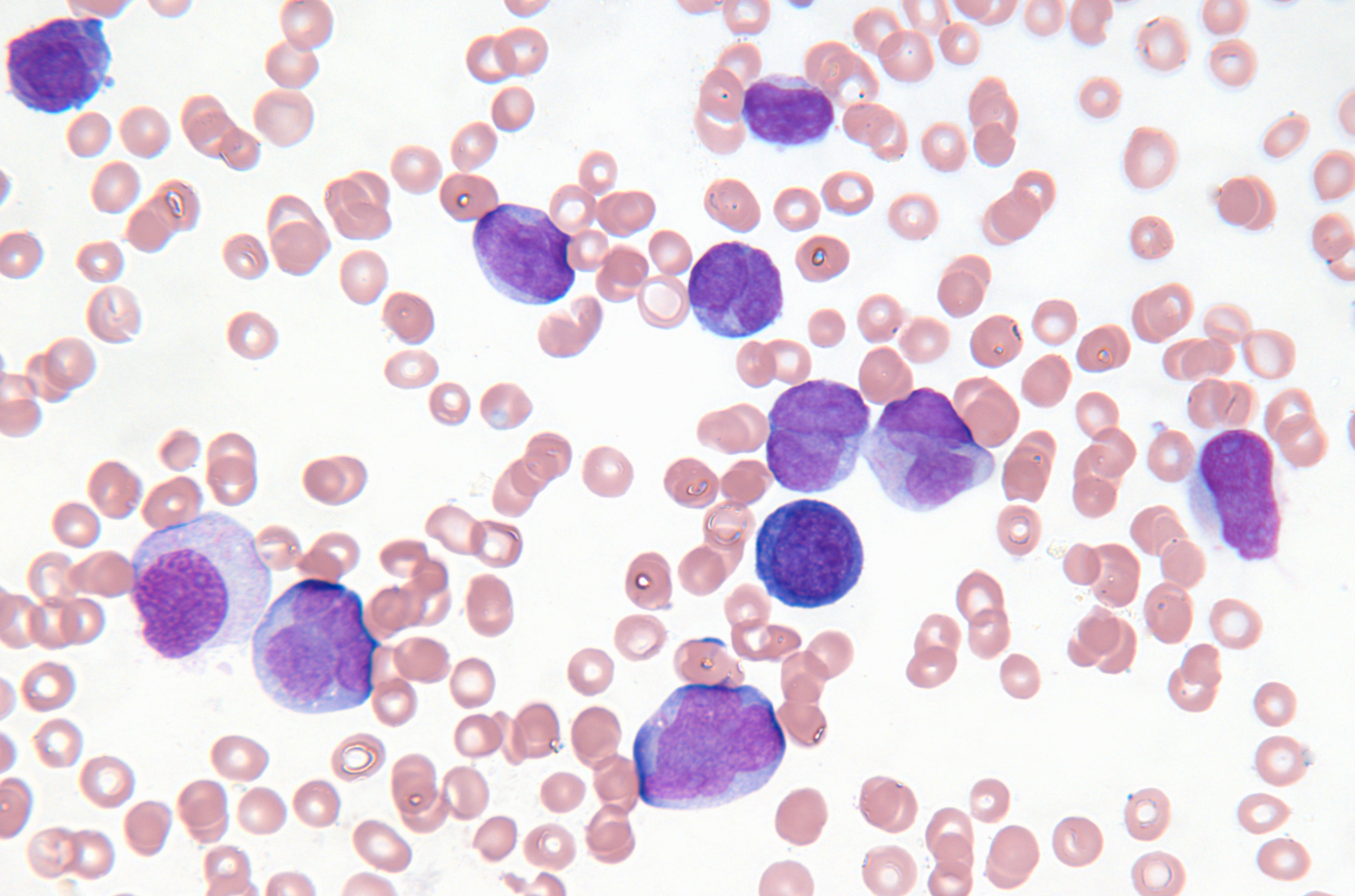 Leukemia cancer cells microscope