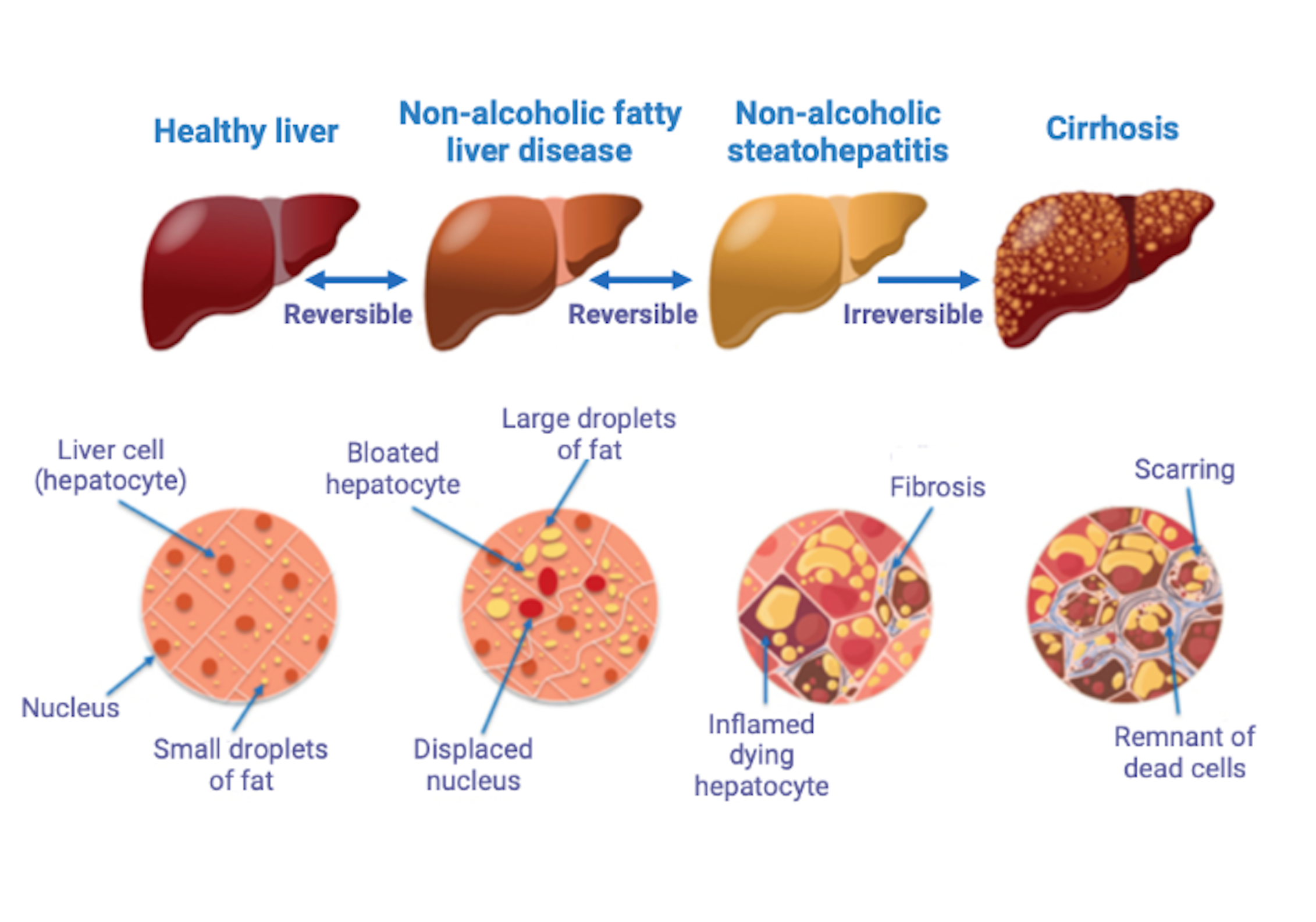 human liver fatty liver disease