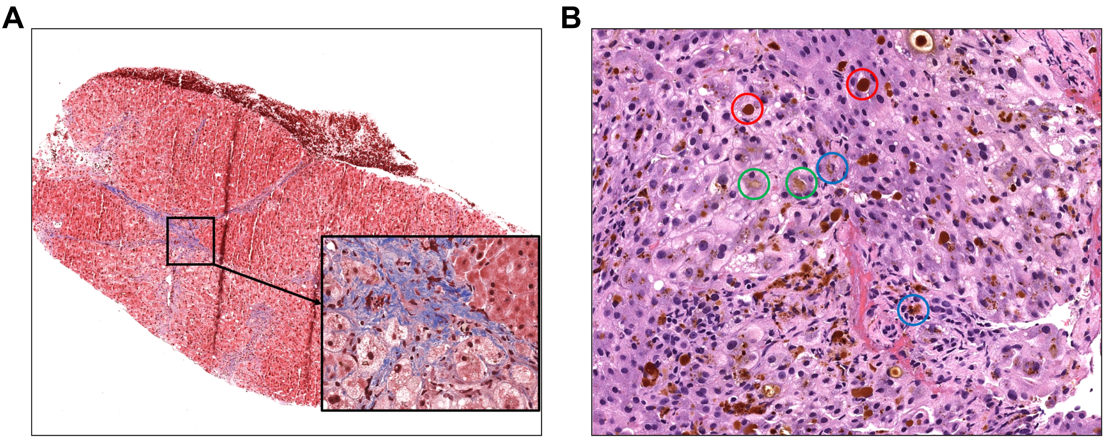 liver fibrosis histology biopsy