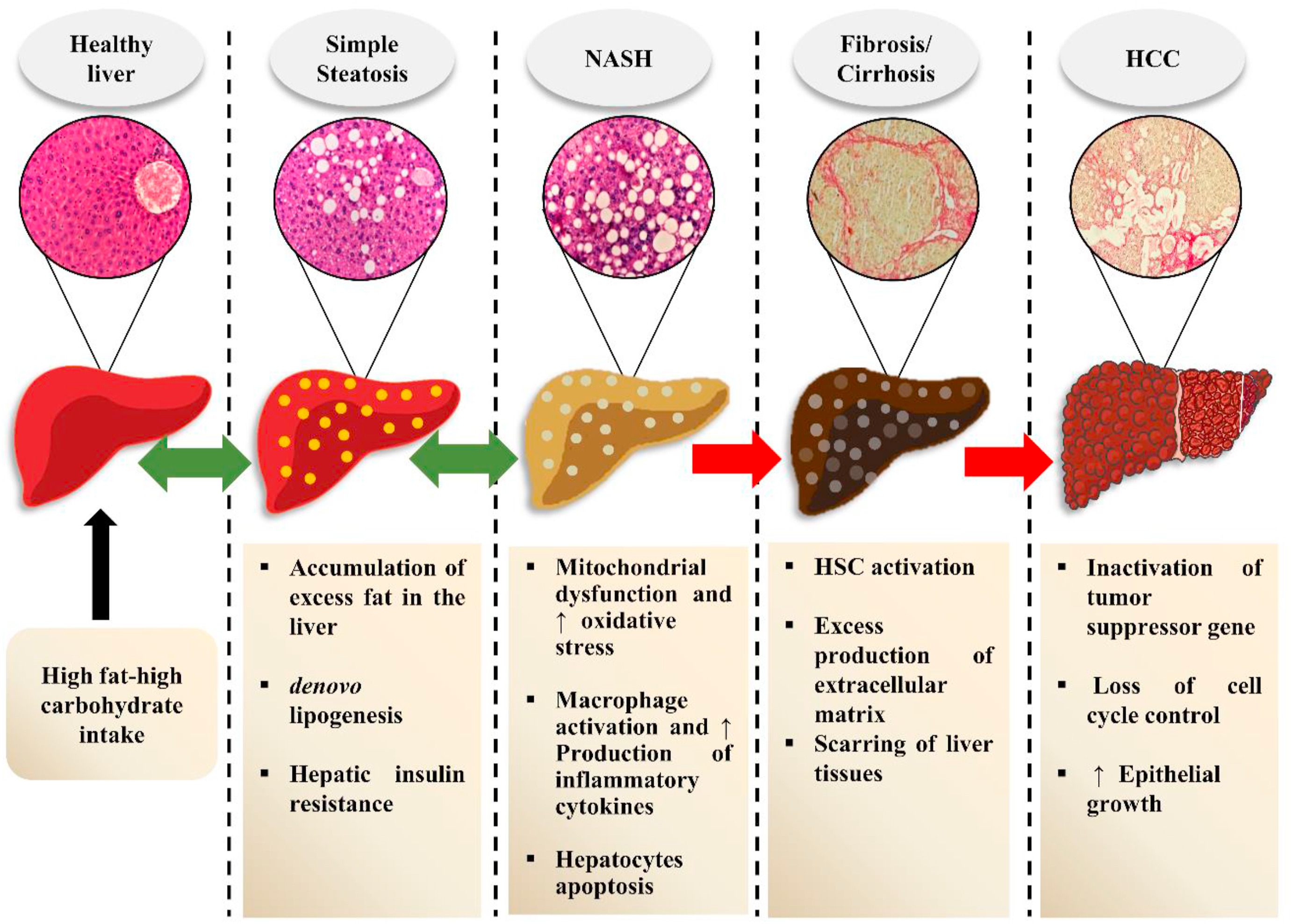 nonalcoholic fatty liver disease illustration