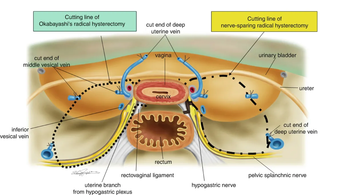 nerve sparing hysterectomy technique
