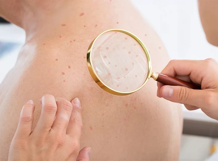 dermatologist examining tattoo skin