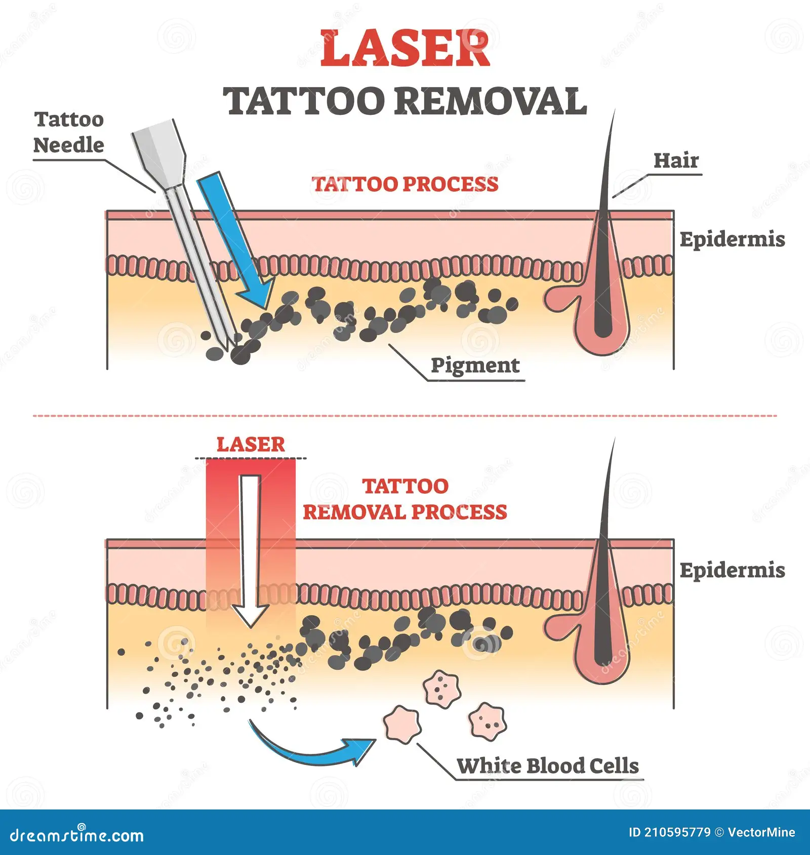 laser tattoo removal process