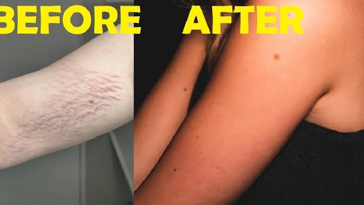 stretch marks on arm