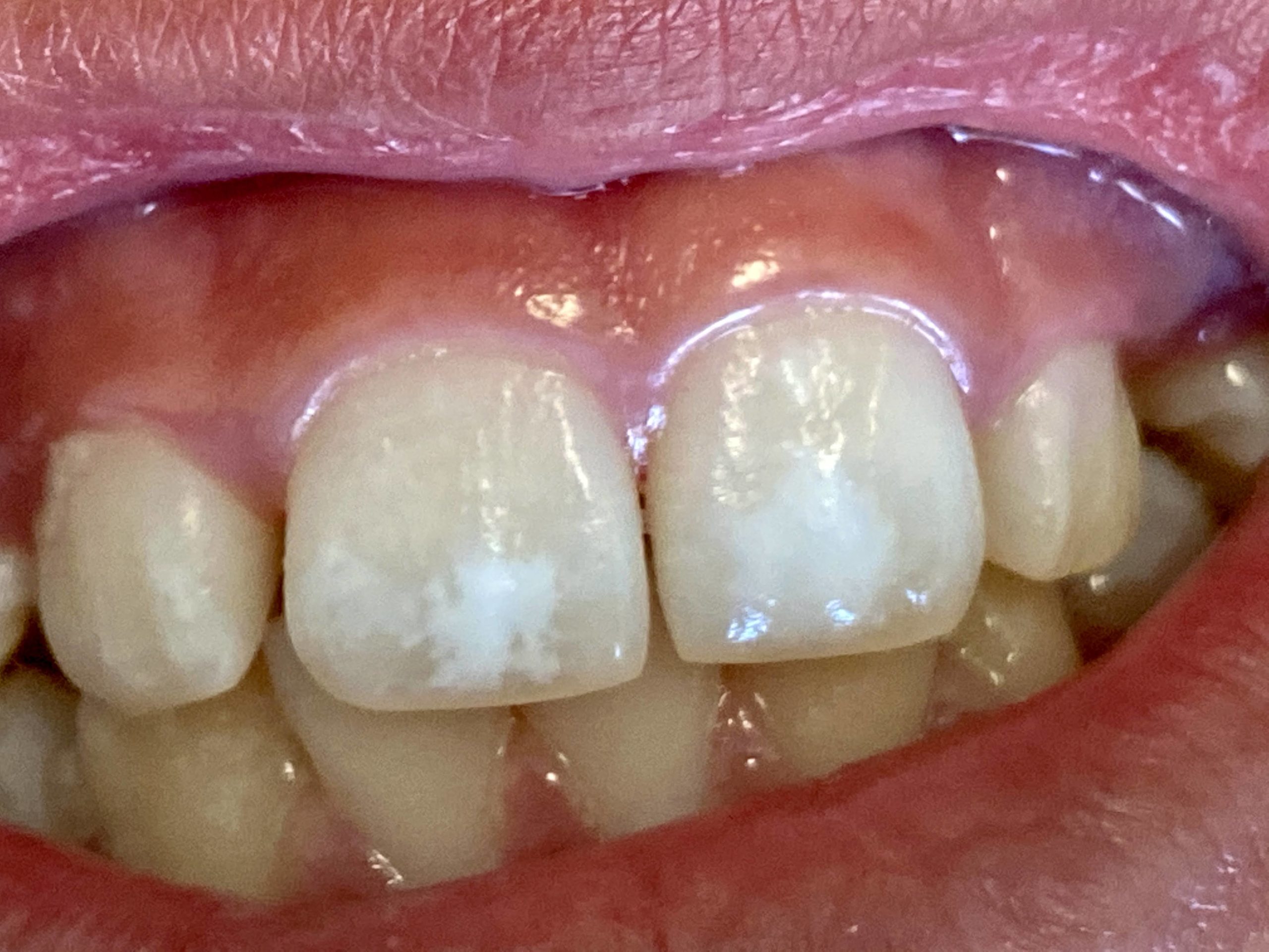 early enamel white spot lesions