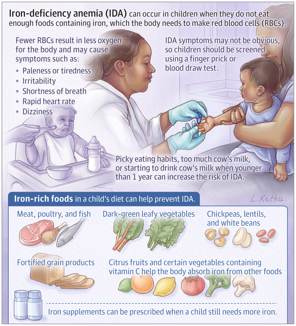Iron deficiency anemia children