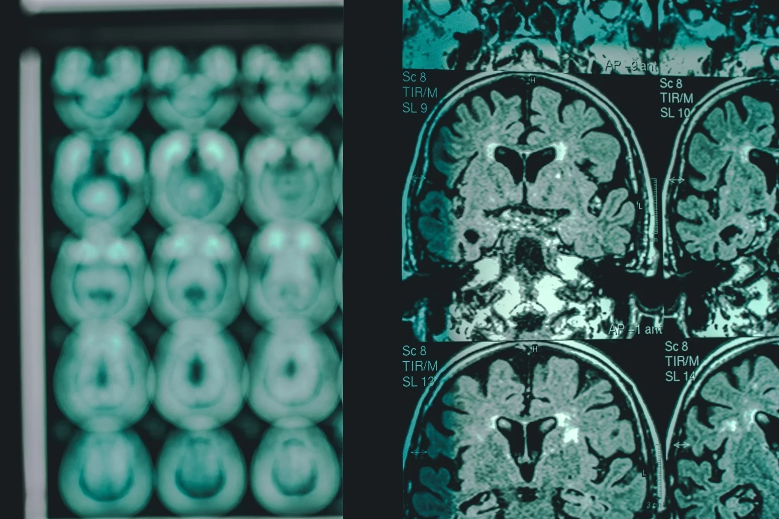 Glucosamine Linked to Faster Alzheimer’s Progression — What to Know
