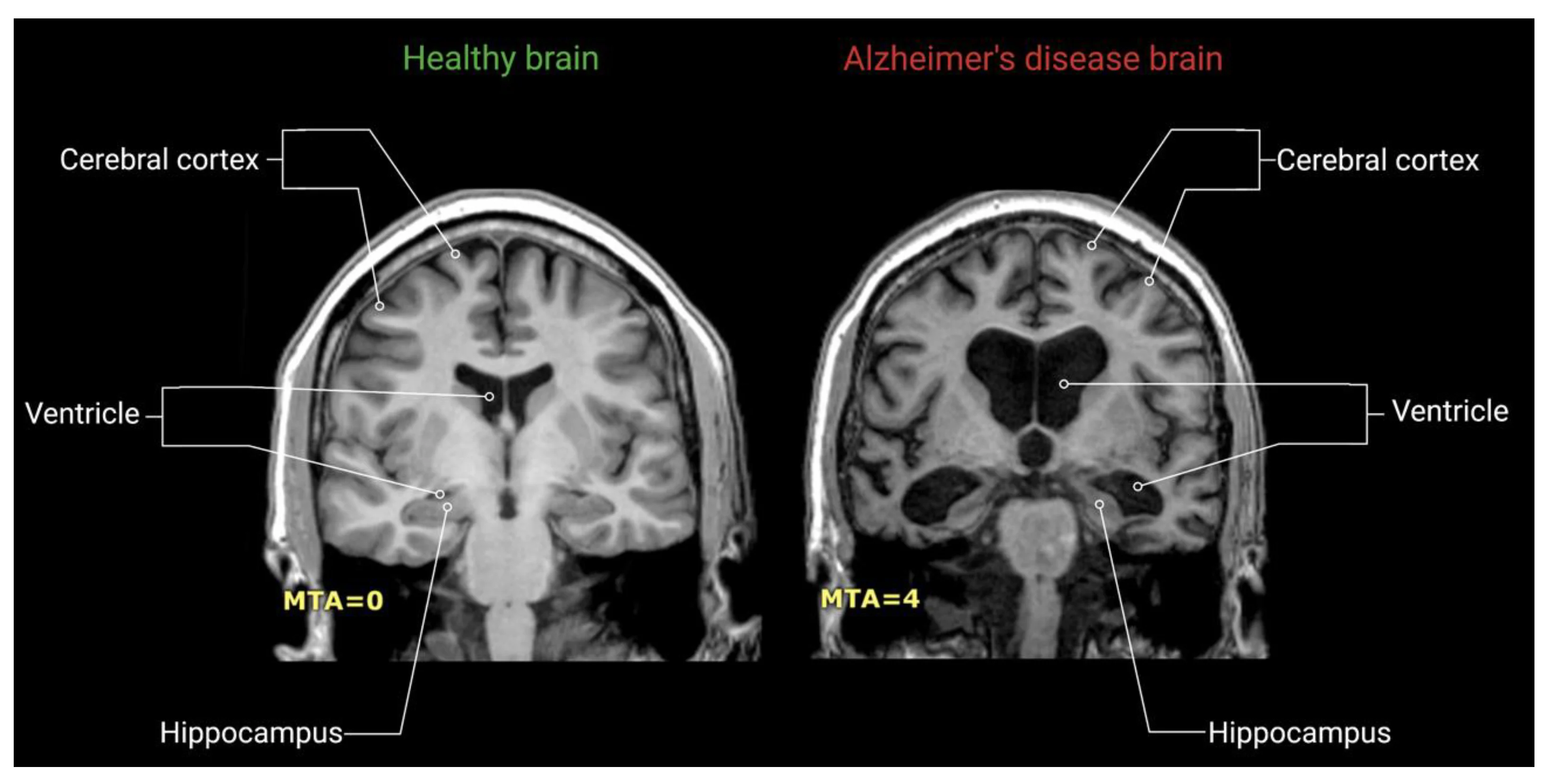 Alzheimer's disease brain scan