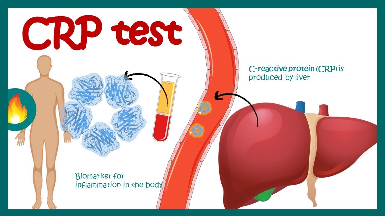 CRP blood test inflammation