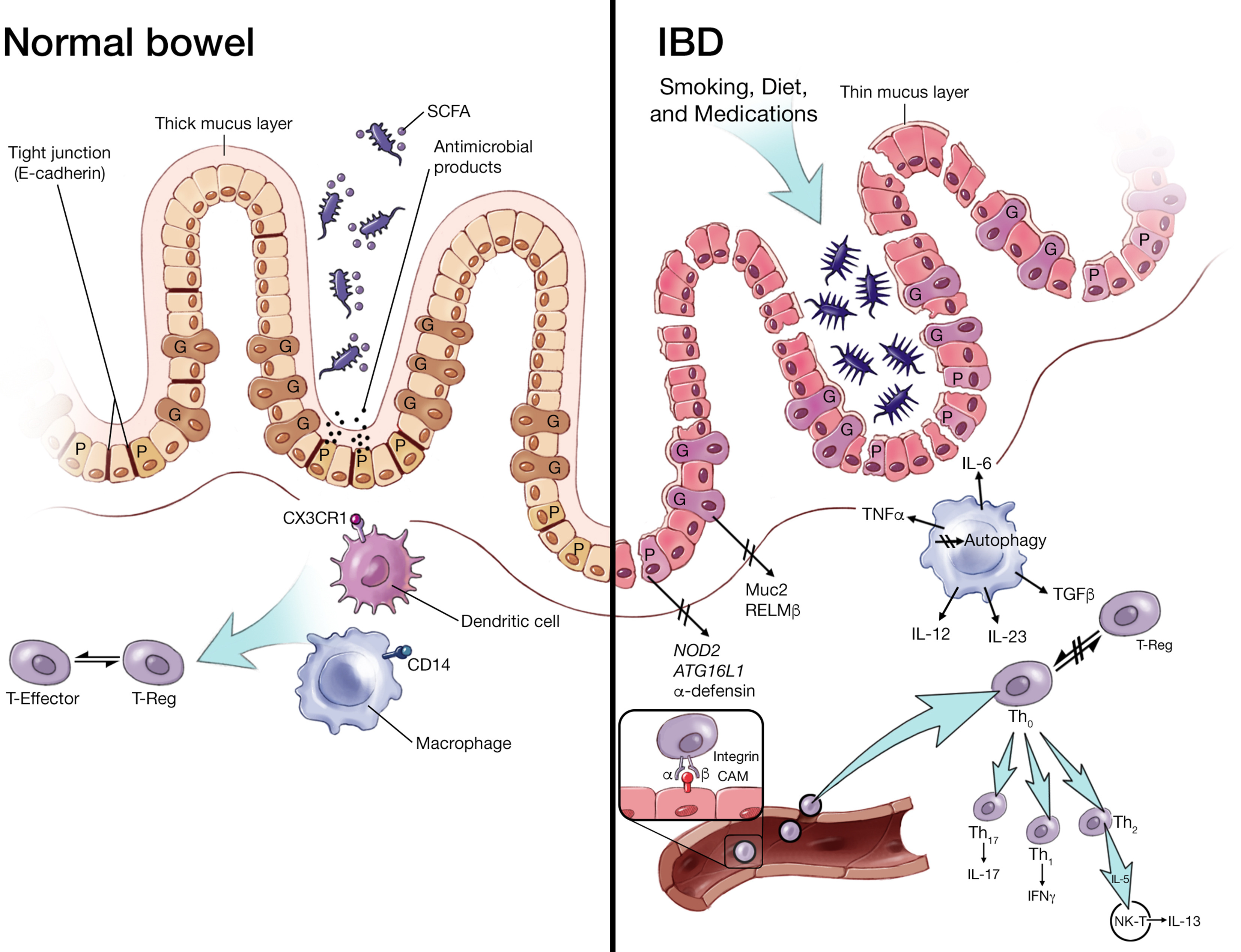 Hidden Gut Defects Behind Recurrent IBD: Why It Keeps Returning
