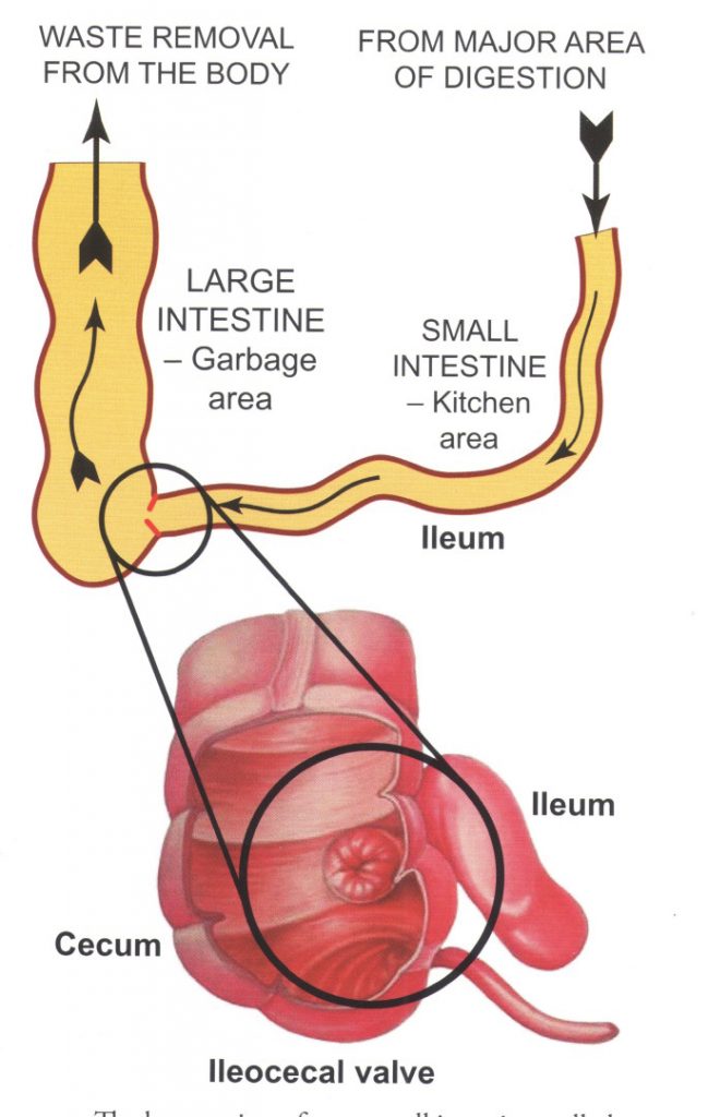 ileocecal valve Crohn disease