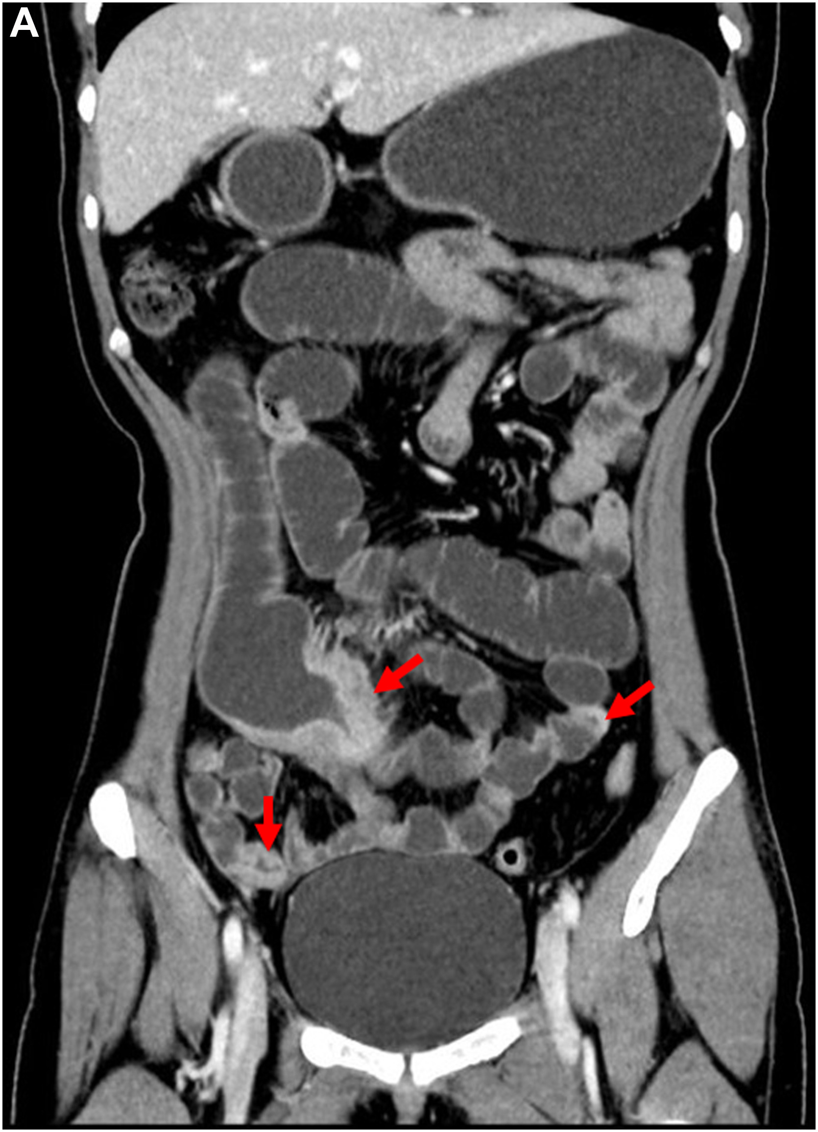 small bowel stricture IBD