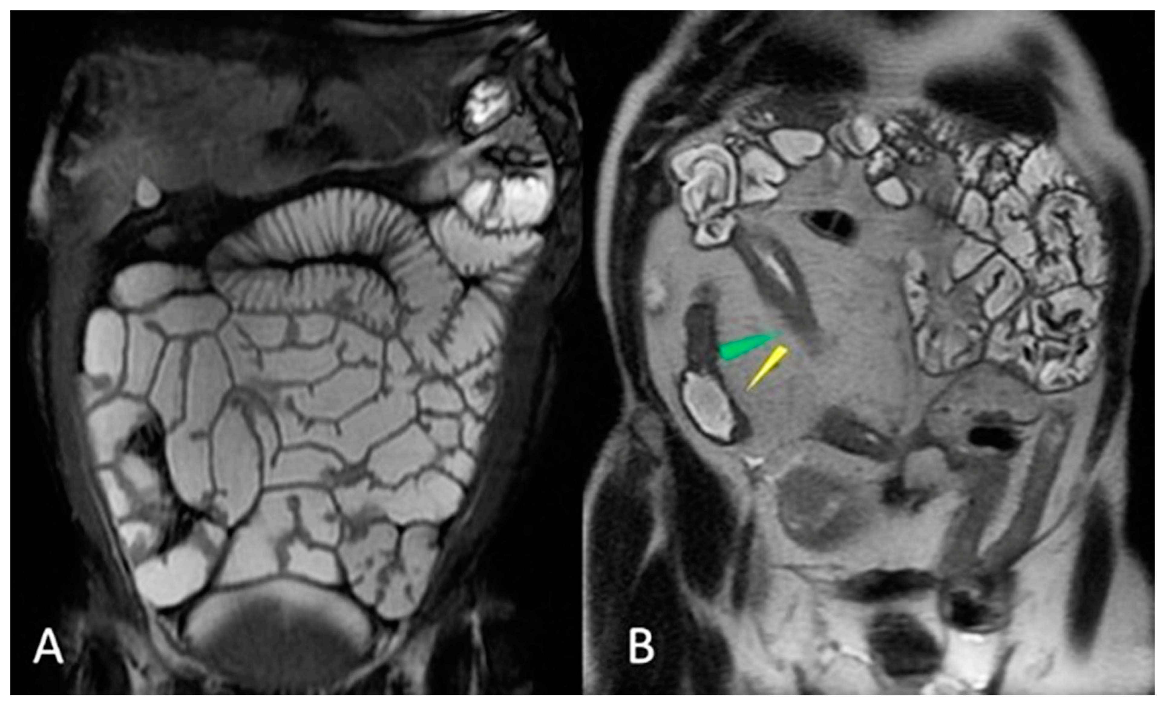 MR enterography small intestine