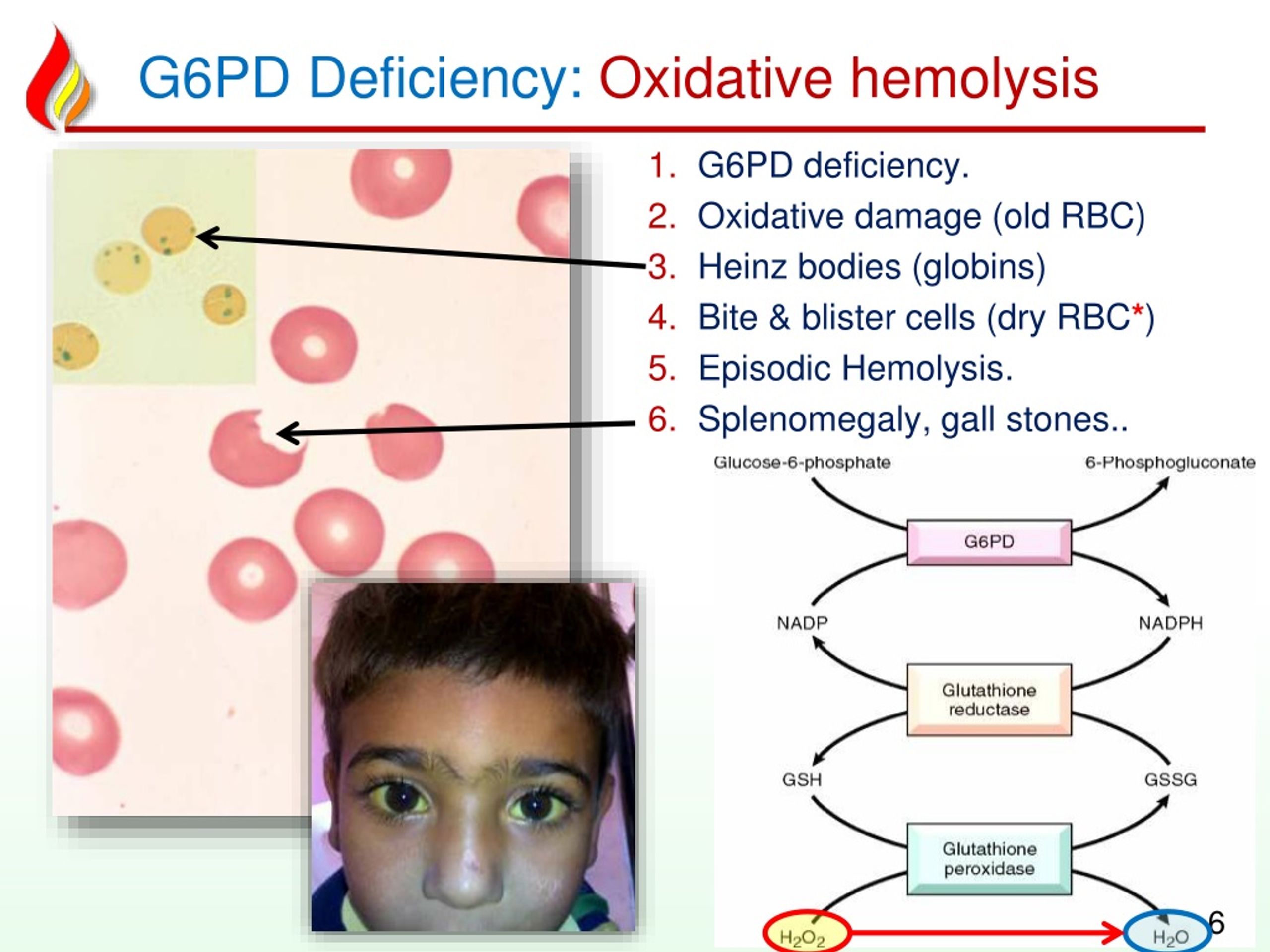 G6PD deficiency blood hemolysis illustration