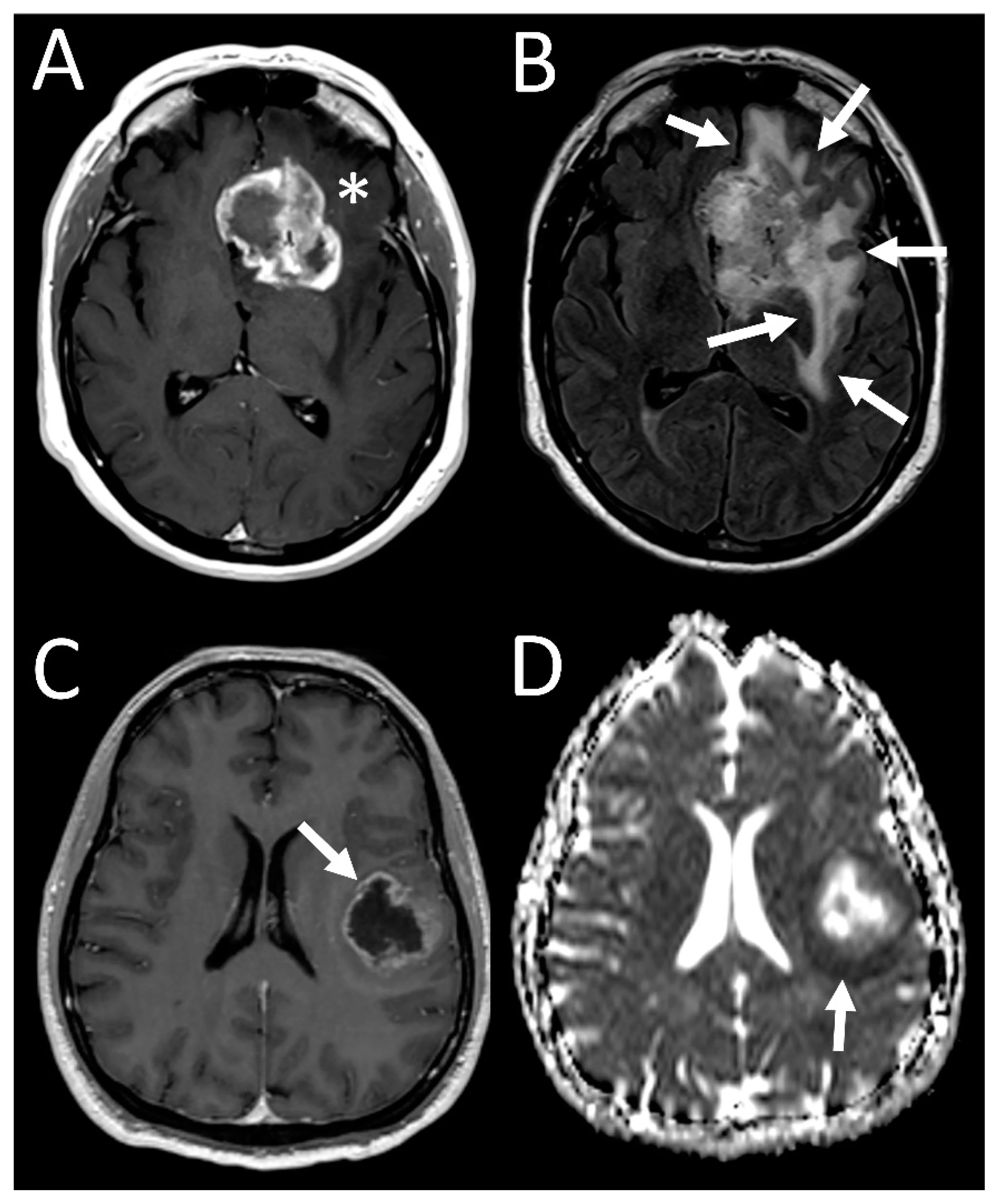 MRI scan of a glioblastoma brain tumor
