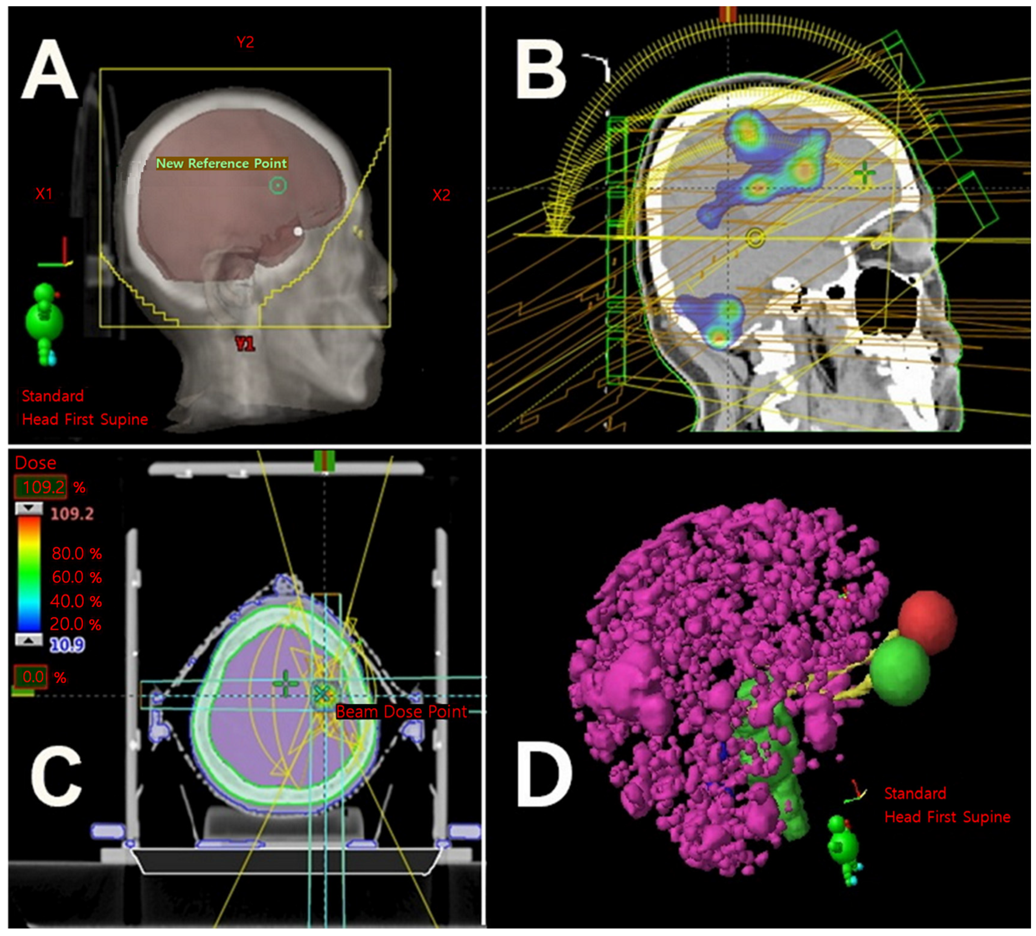 Radiation therapy for brain cancer