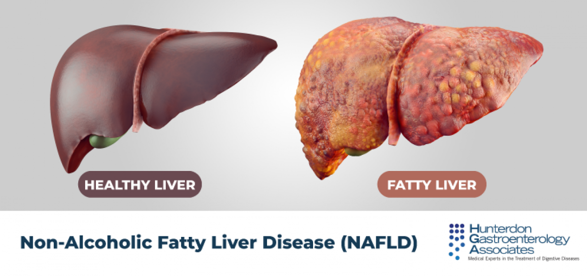 nonalcoholic fatty liver disease