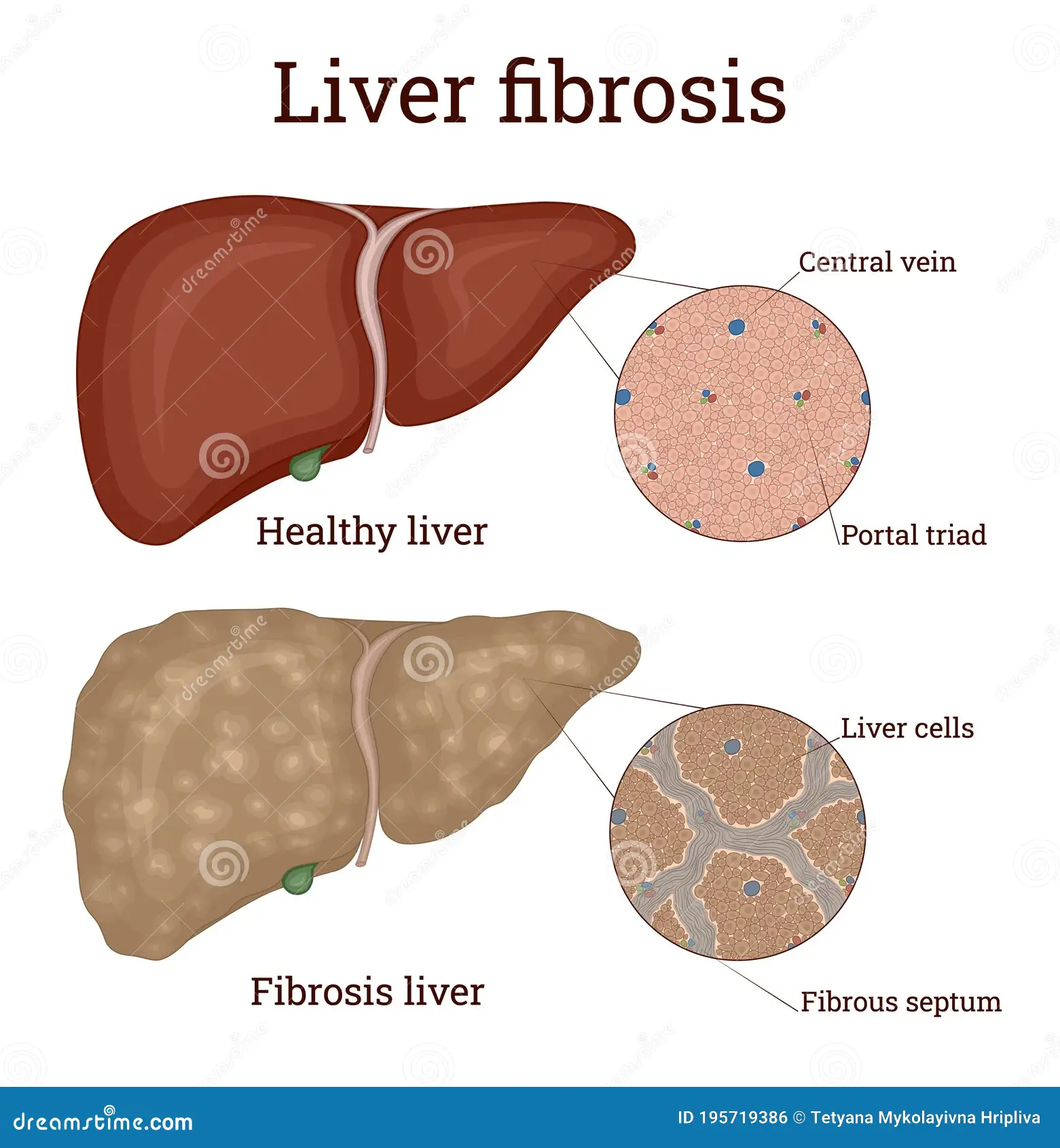 liver fibrosis scarring diagram