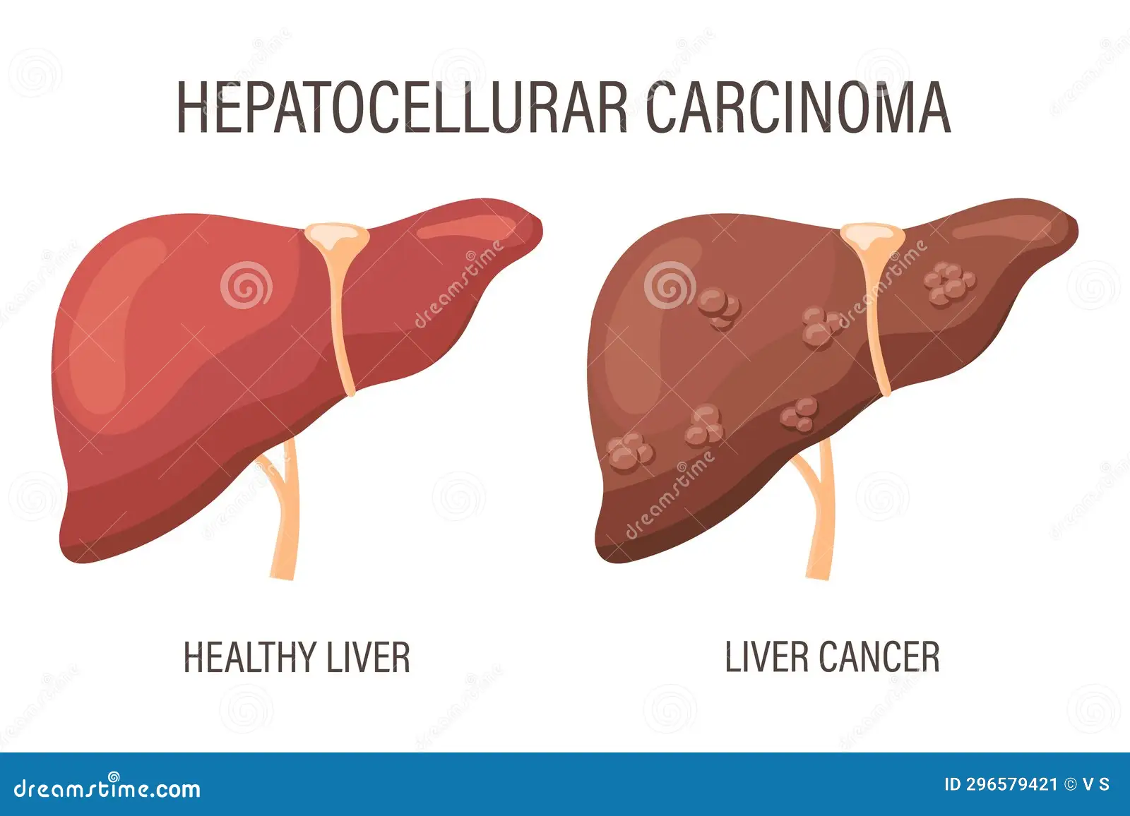 hepatocellular carcinoma liver cancer