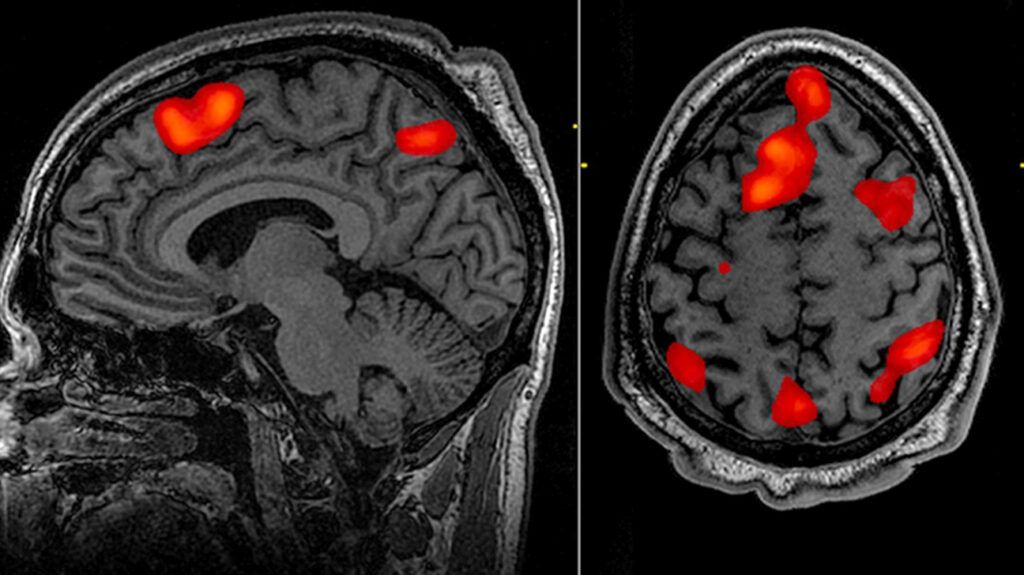 fMRI brain scan imaging