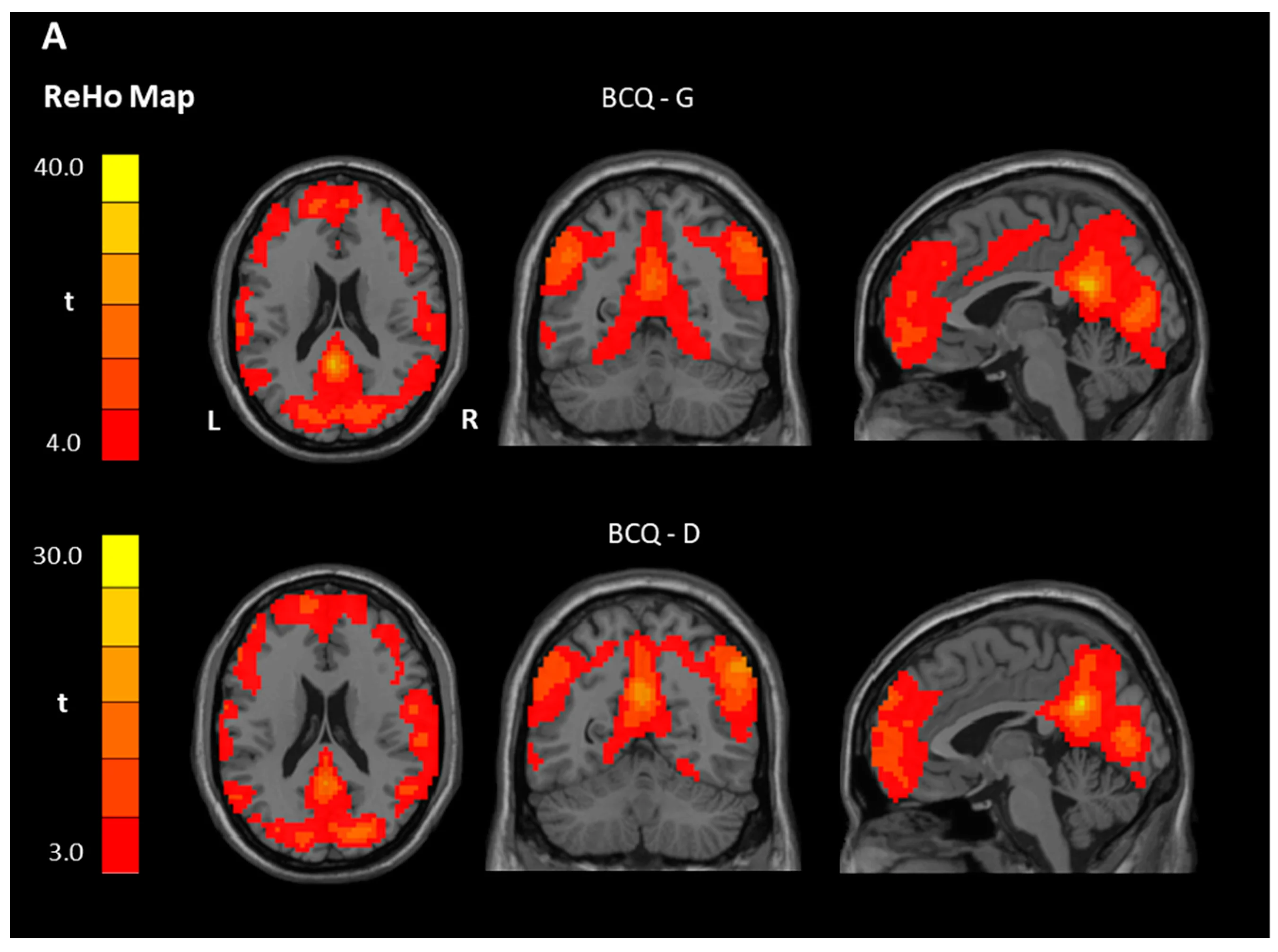 fMRI brain activity mapping