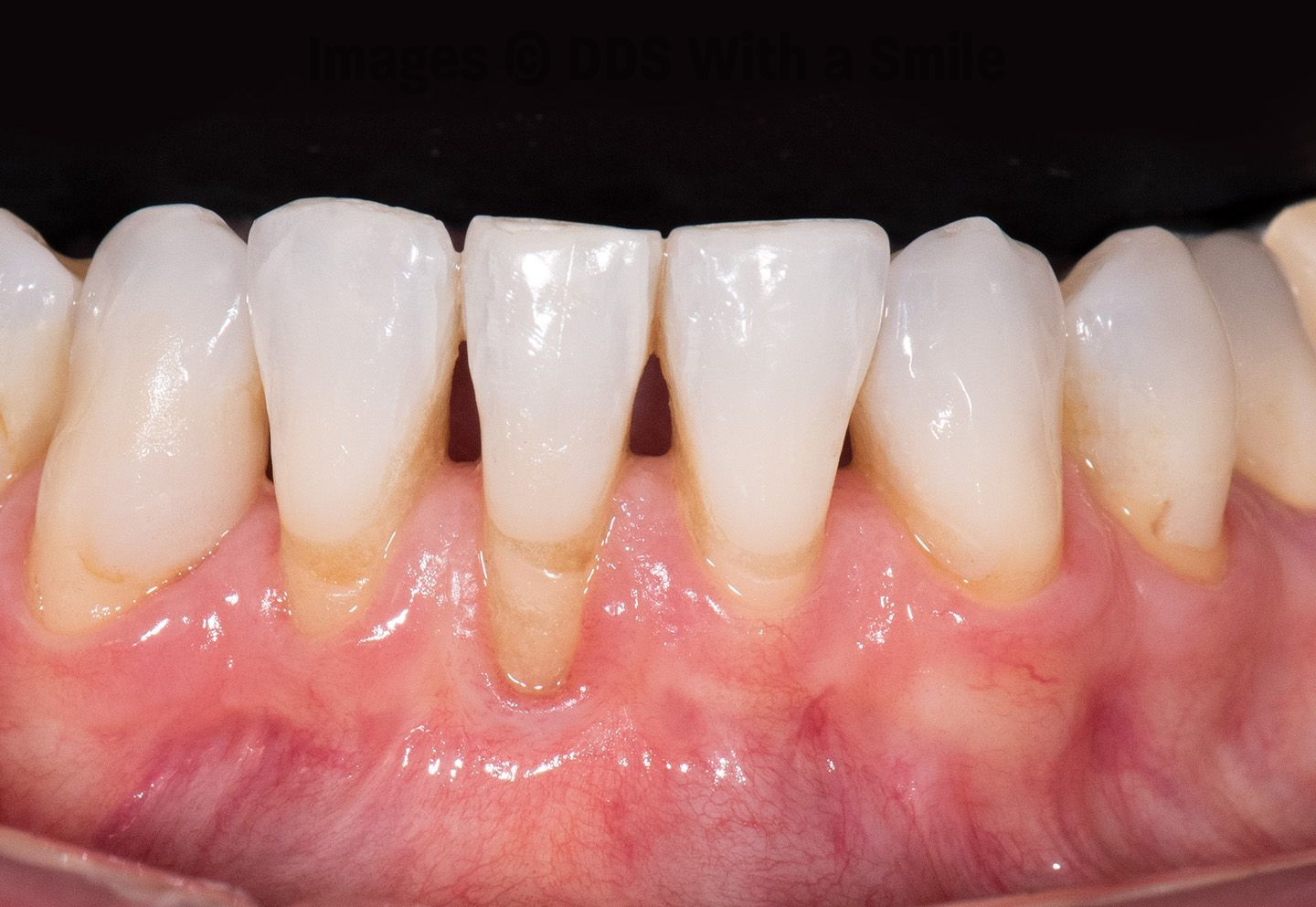 I Brushed Wrong for 28 Years — My Gums Are Ruined. Here's Why
