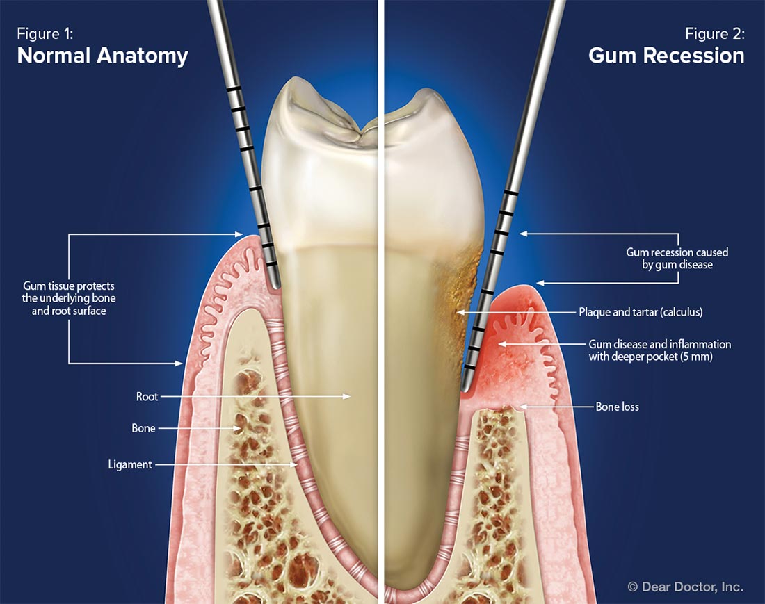 dental gum recession diagram