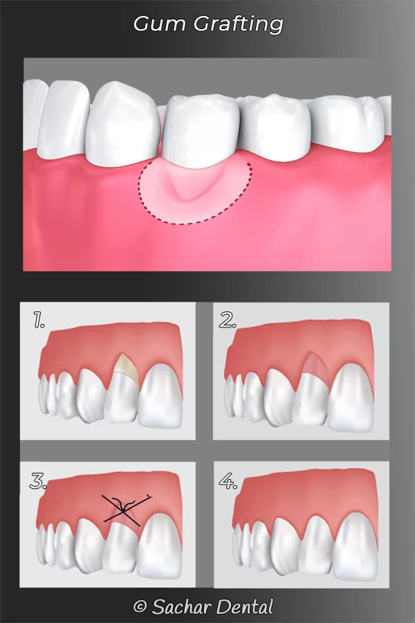 periodontal gum grafting procedure