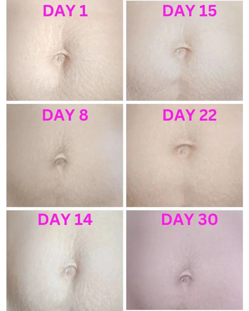 Living with Post-Pregnancy Stretch Marks: My 7-Year Journey