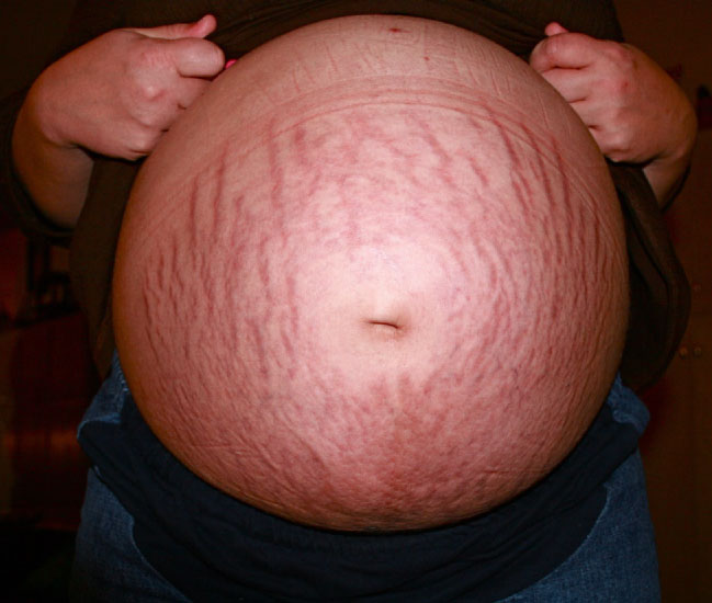 pregnancy stretch marks abdomen
