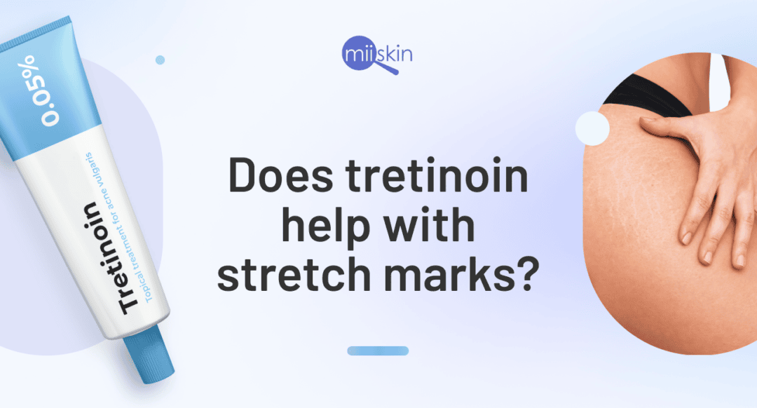 tretinoin cream for stretch marks