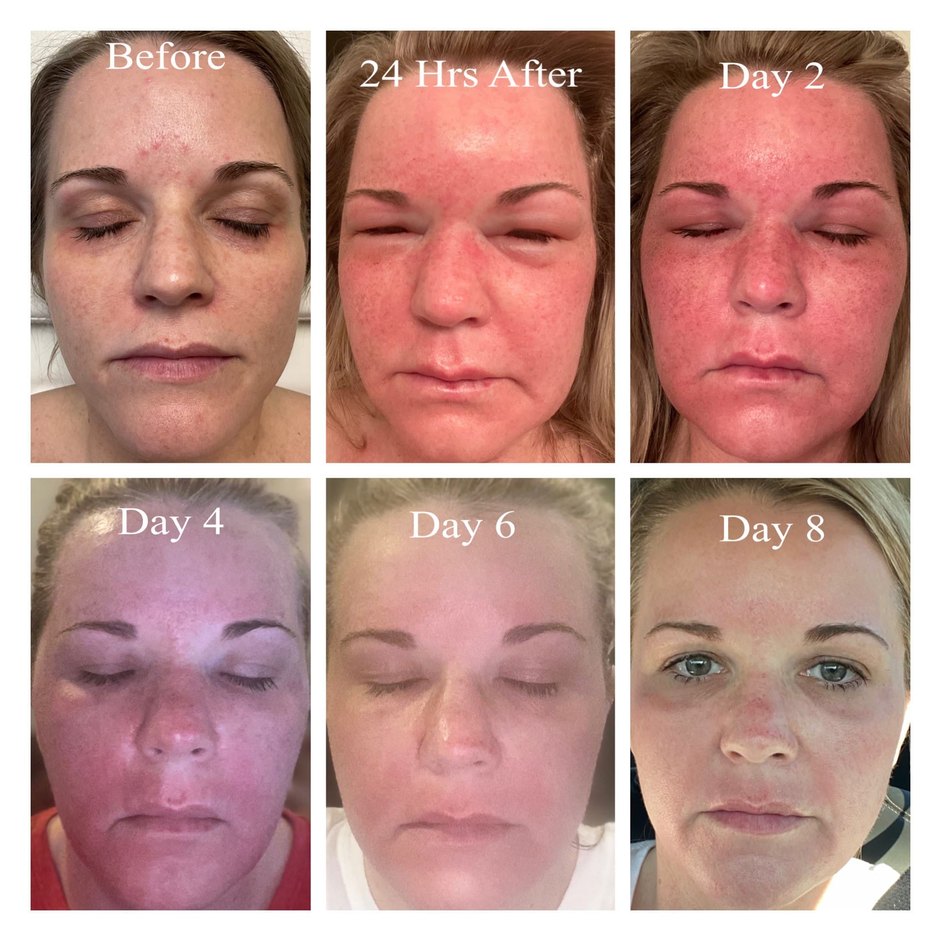fractionated laser skin therapy