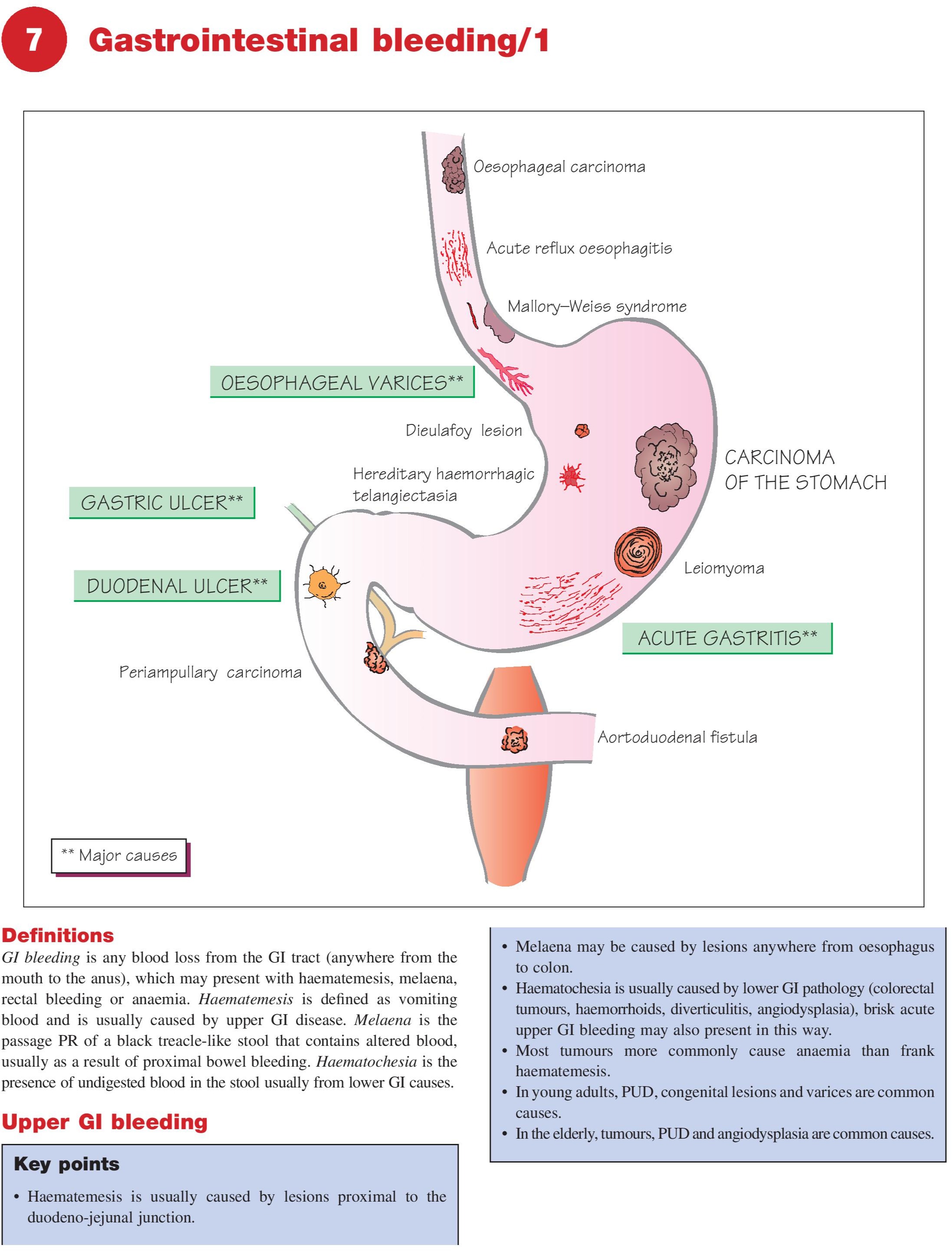 gastrointestinal bleeding medical diagram