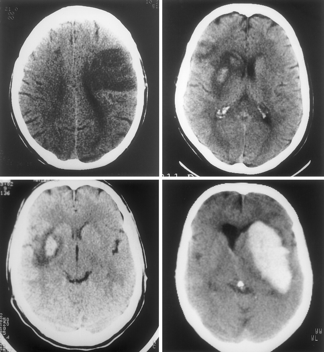 hemorrhagic stroke brain scan