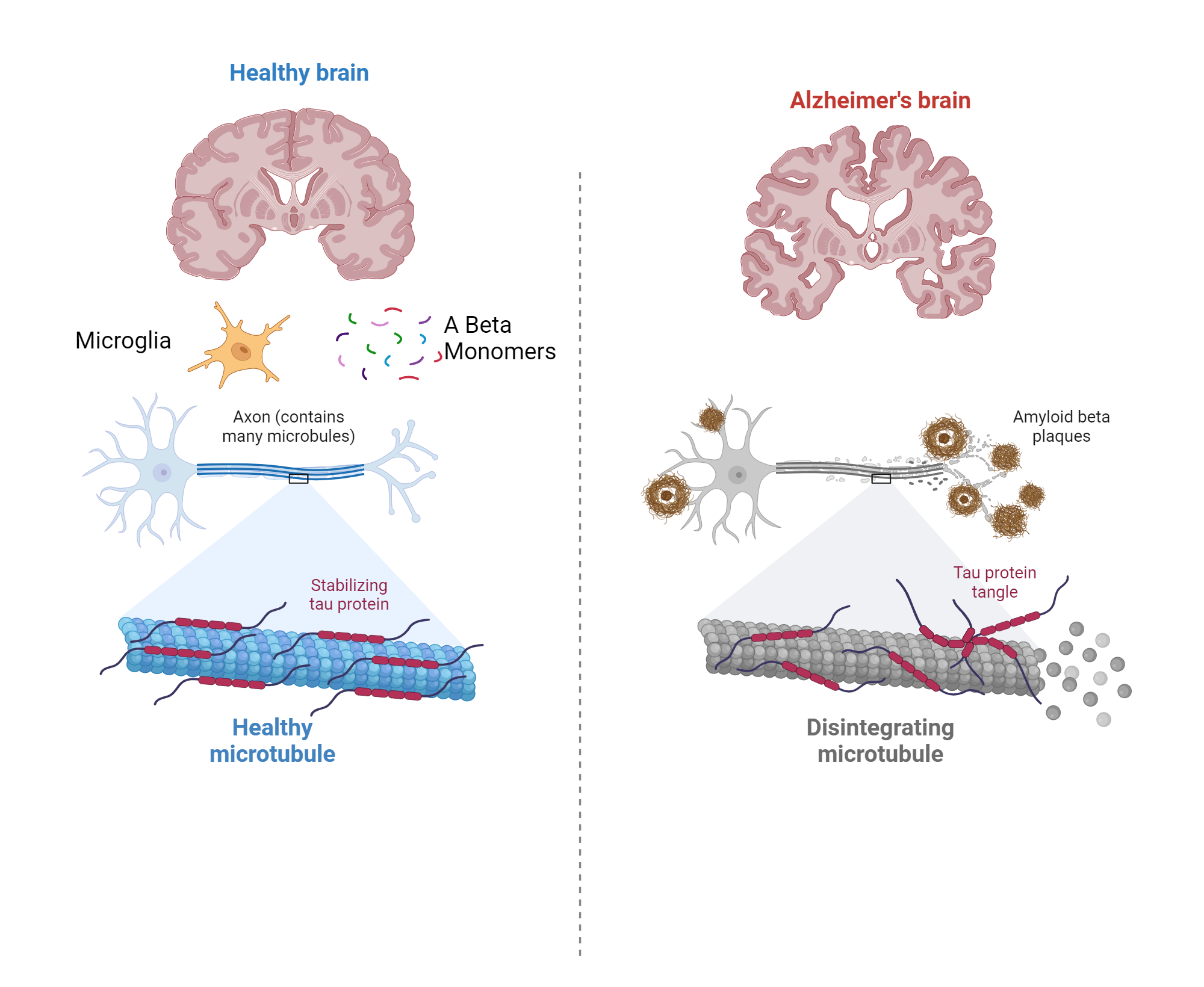 Alzheimer's disease brain pathology