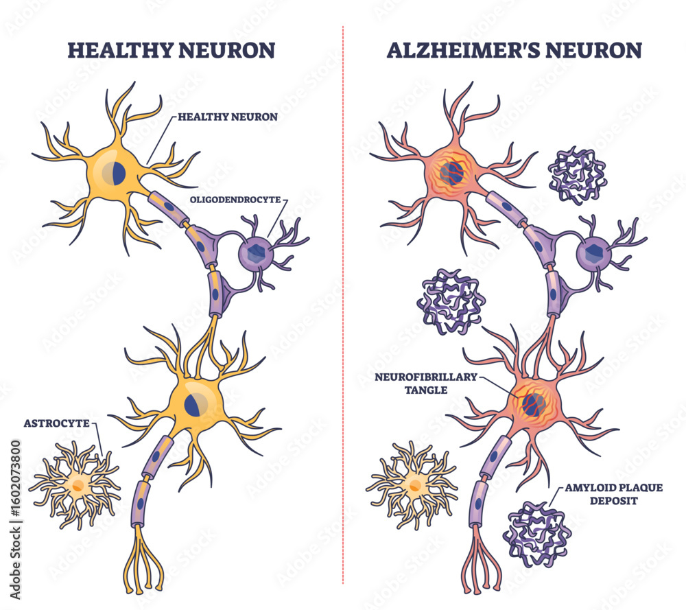 neuron synapse Alzheimer's disease