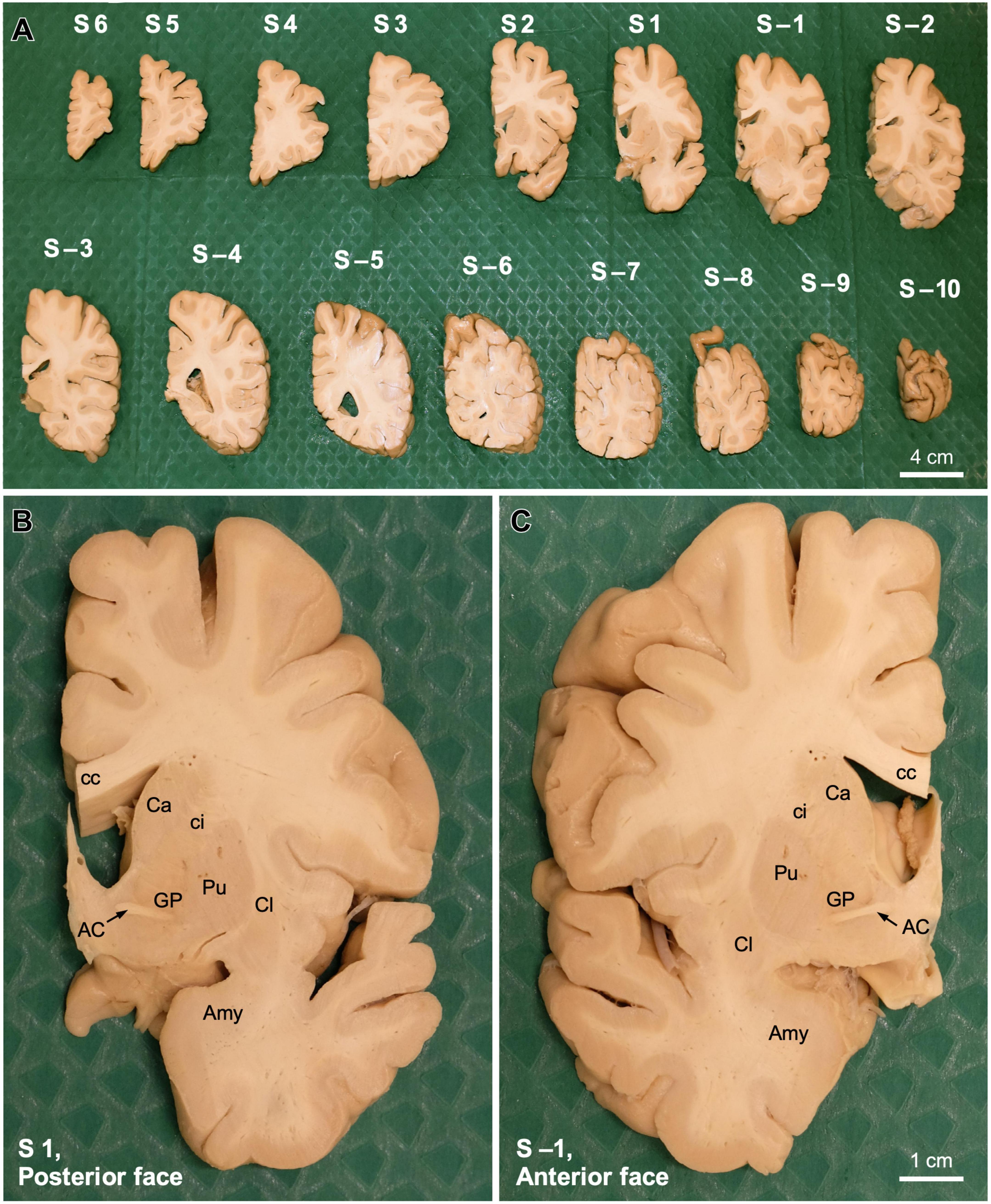 human postmortem brain tissue