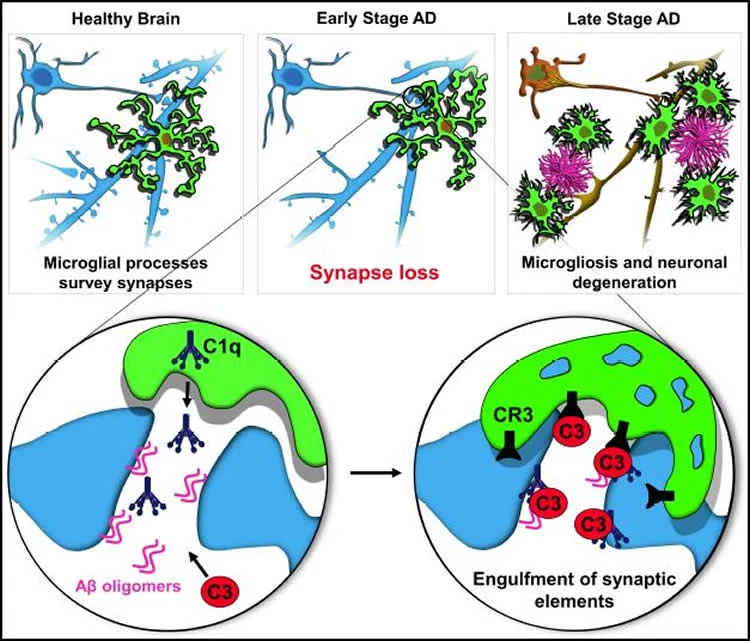 synaptic loss Alzheimer's disease