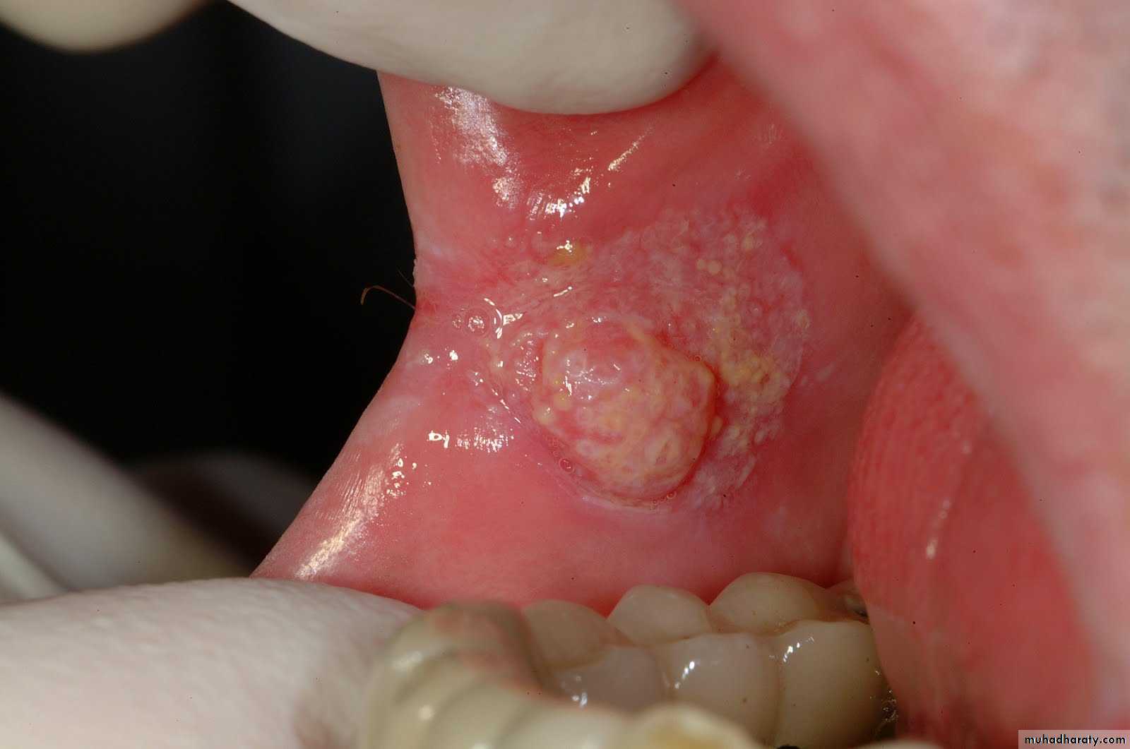 oral cancer mucosal lesions